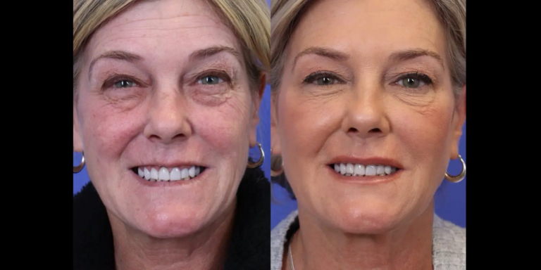 1120 New-5-29-Botox B&A2