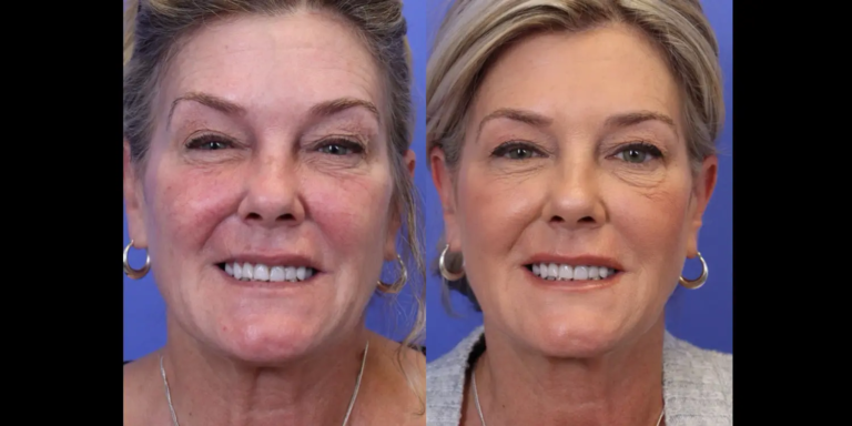 1120 New-5-29-Botox B&A3