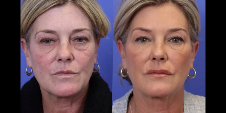 1121 New-5-29-Filler B&A