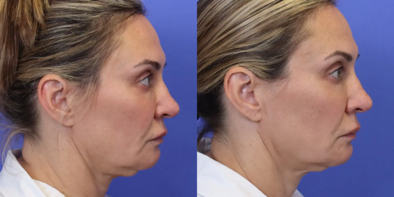 1122 New-5-29-EmFace Submentum B&A4