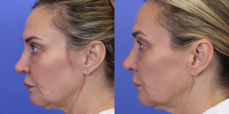 1122 New-5-29-EmFace Submentum B&A6