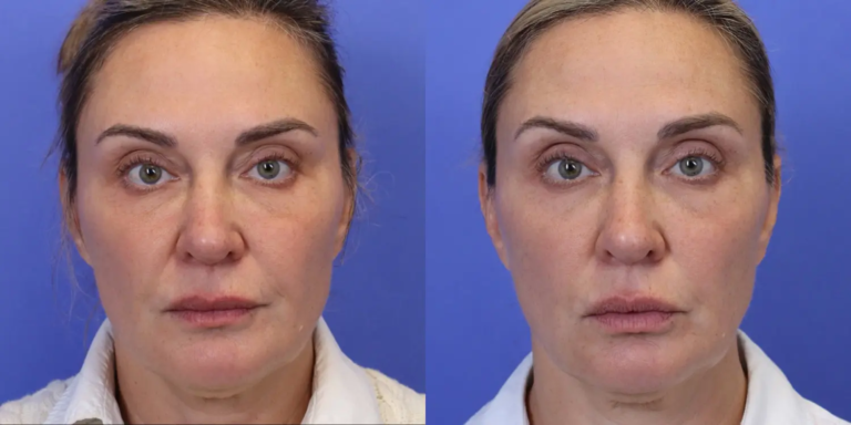 1123 New-5-29-EmFace B&A5