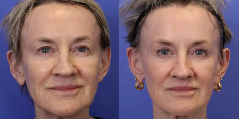 1126A Emface and Exion MNRF3