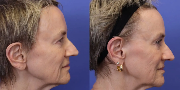 1126B Emface and Exion MNRF