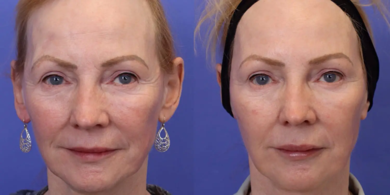 Botox example 1127