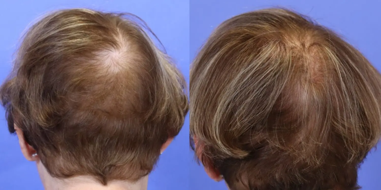 1128A Hair Keralase 1