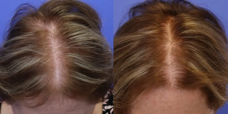 1128B Hair Keralase 2