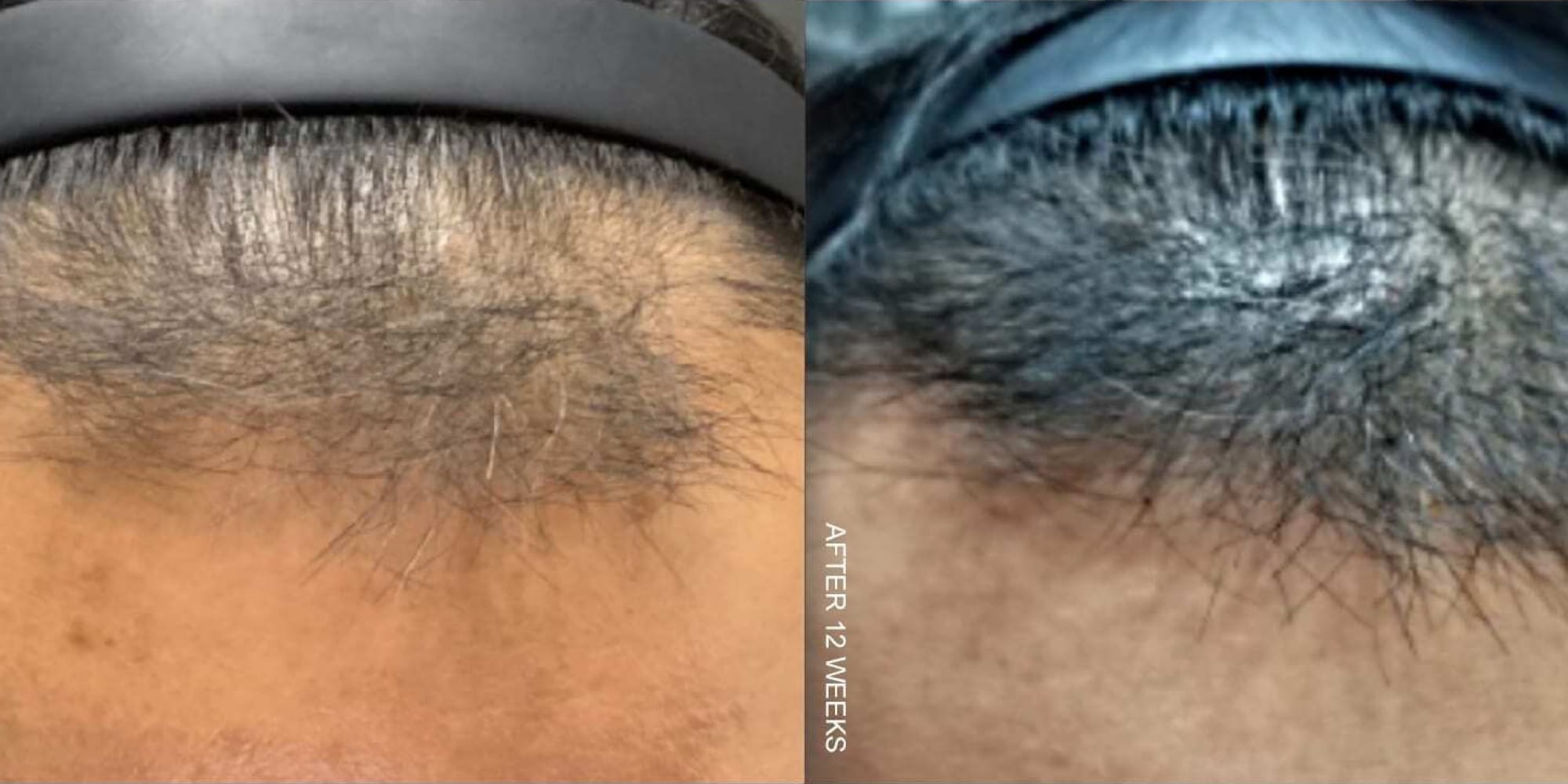 hair loss before and after the hughes center