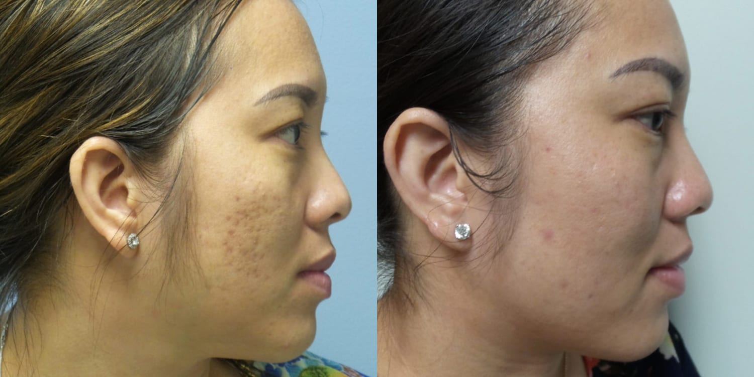 acne before and after the hughes center
