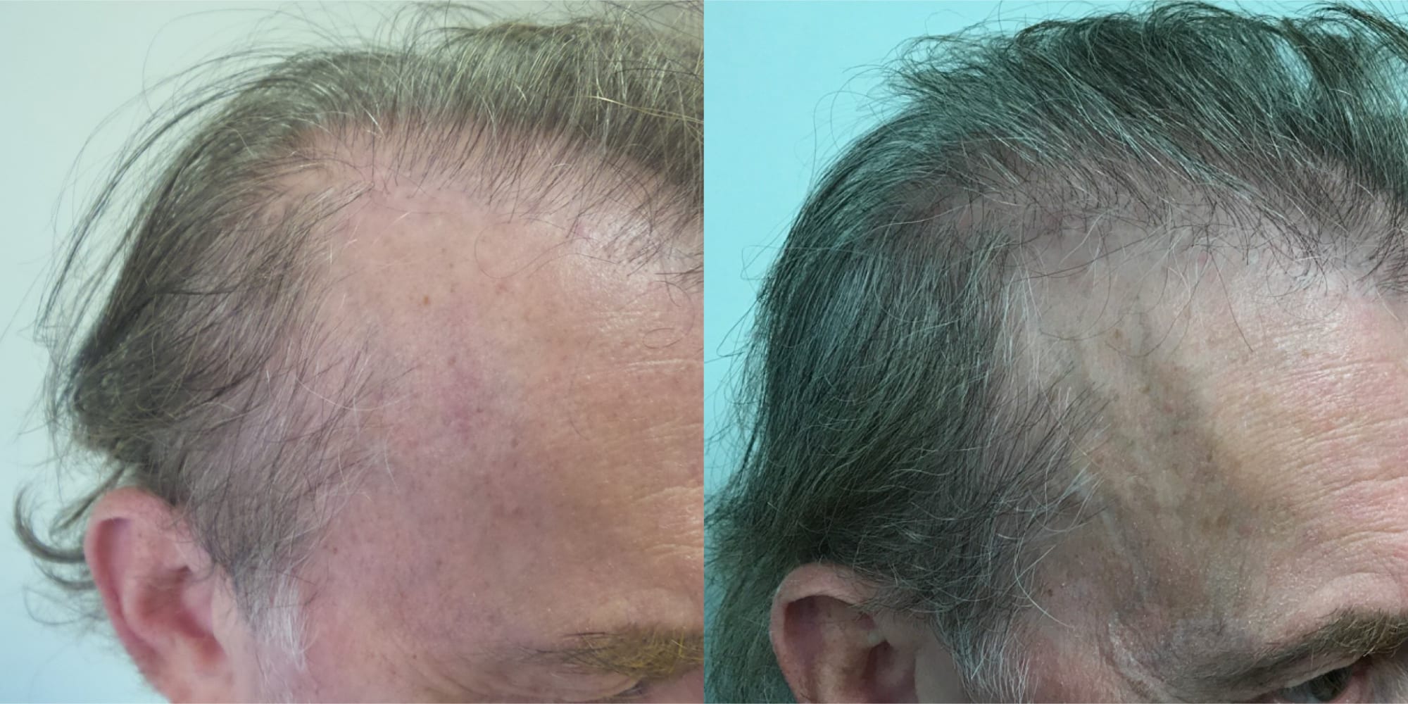 hair restoration before and after hughes center