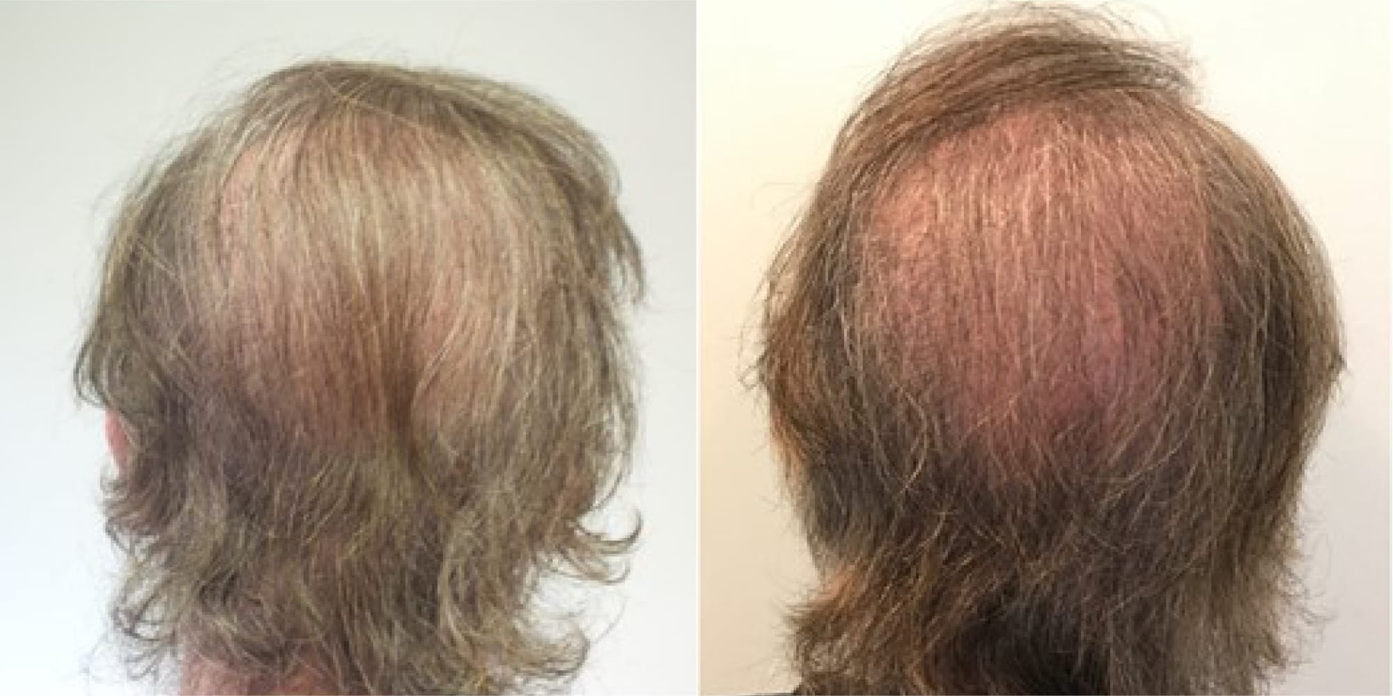 hair restoration before and after hughes center