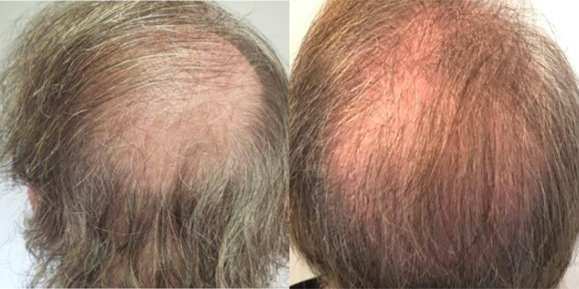 hair restoration before and after hughes center