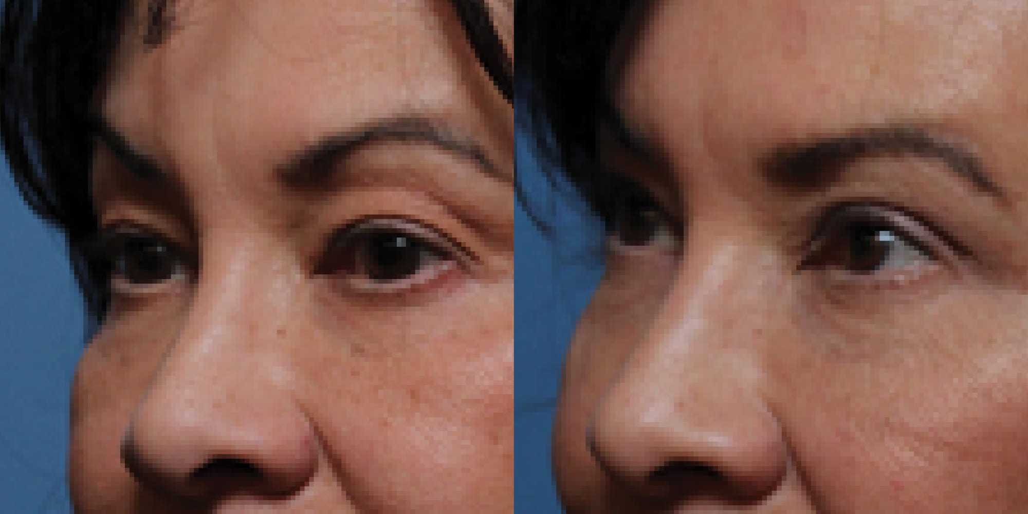 rhinoplasty before and after hughes center