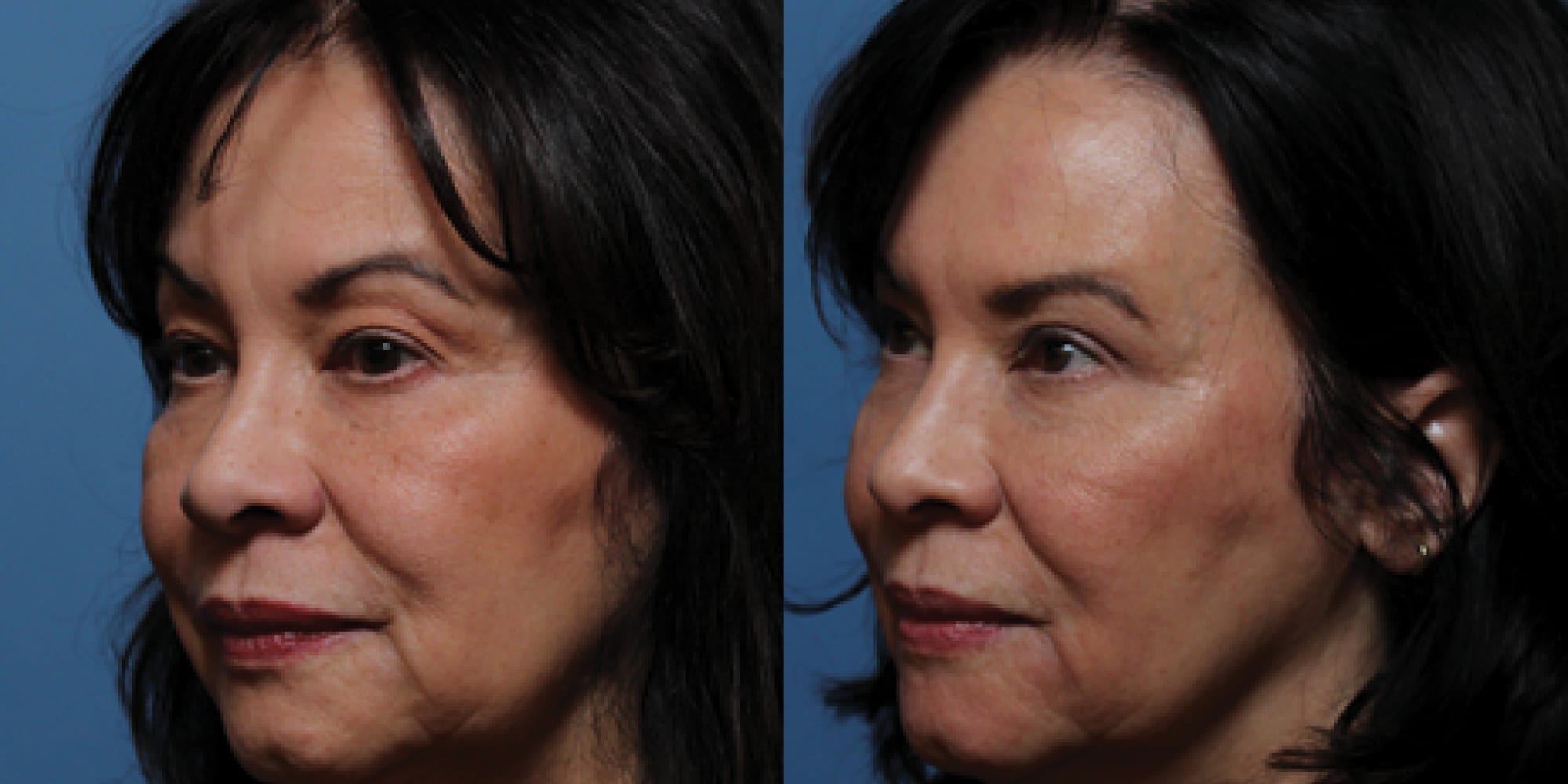 rhinoplasty before and after hughes center
