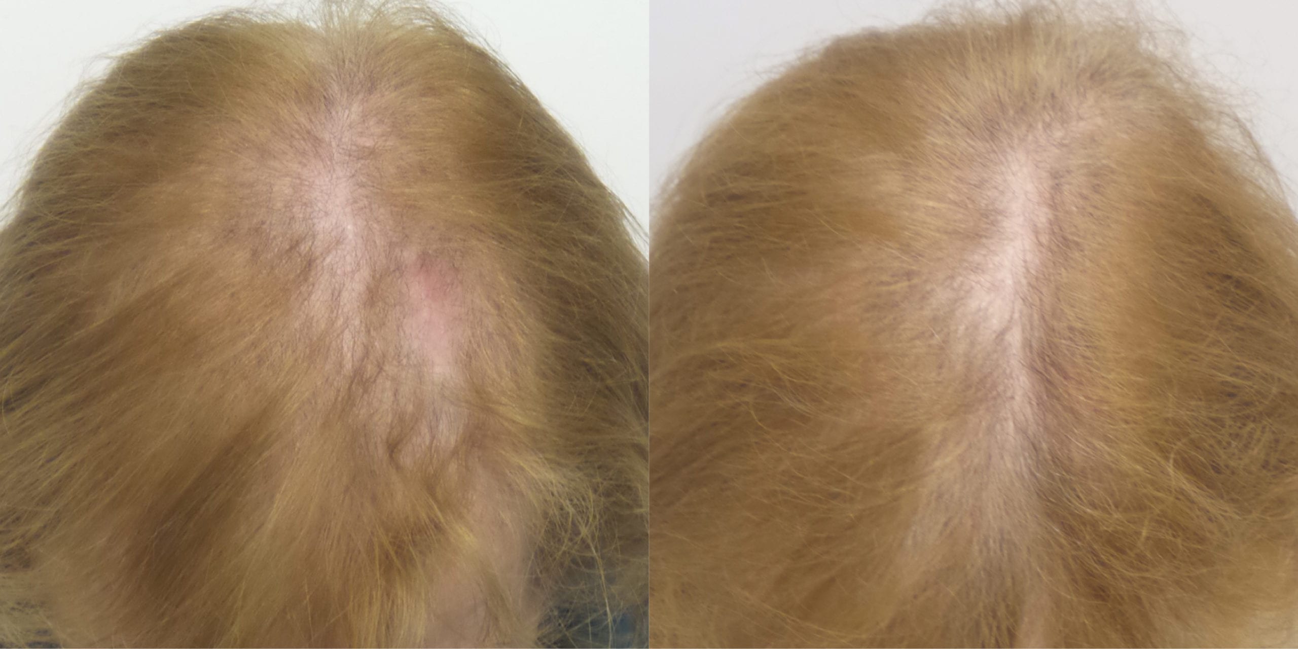Nutrafol Hair Vitamins hughes center