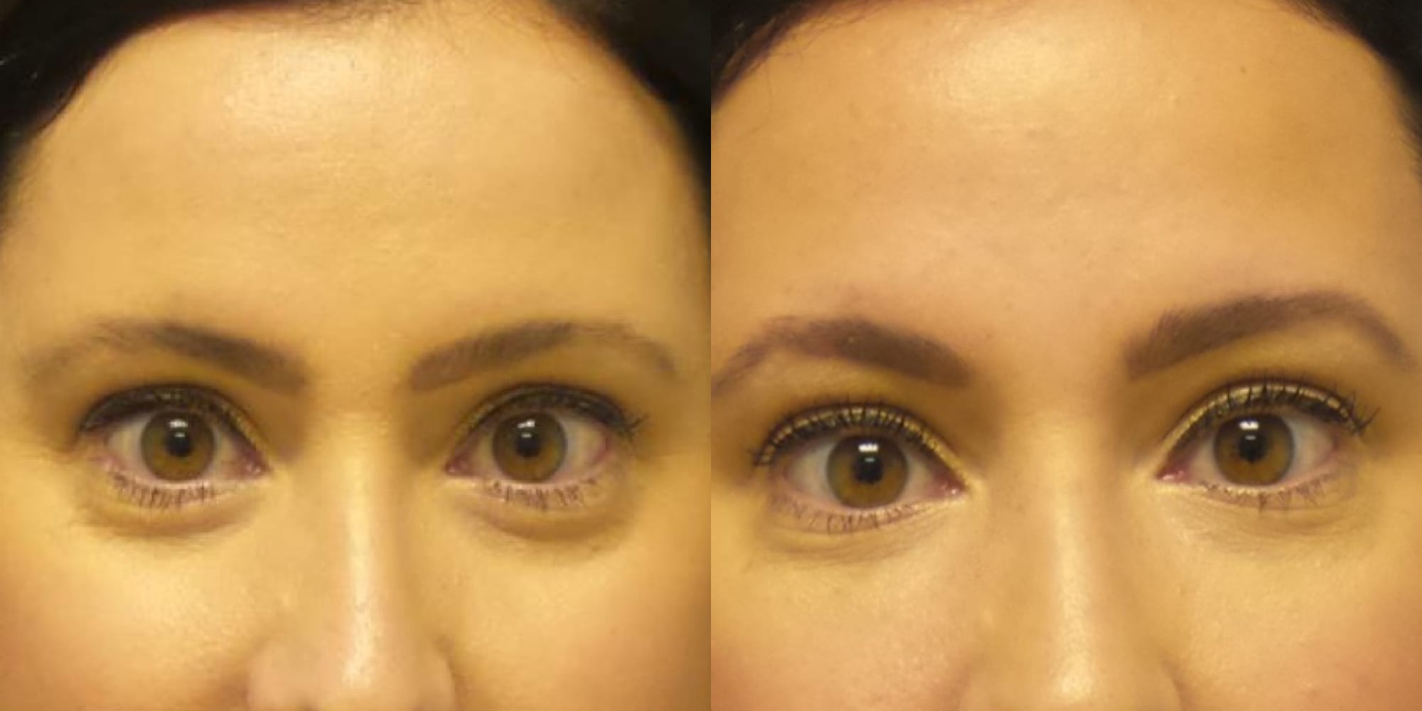 Hughes Center before and after filler woman