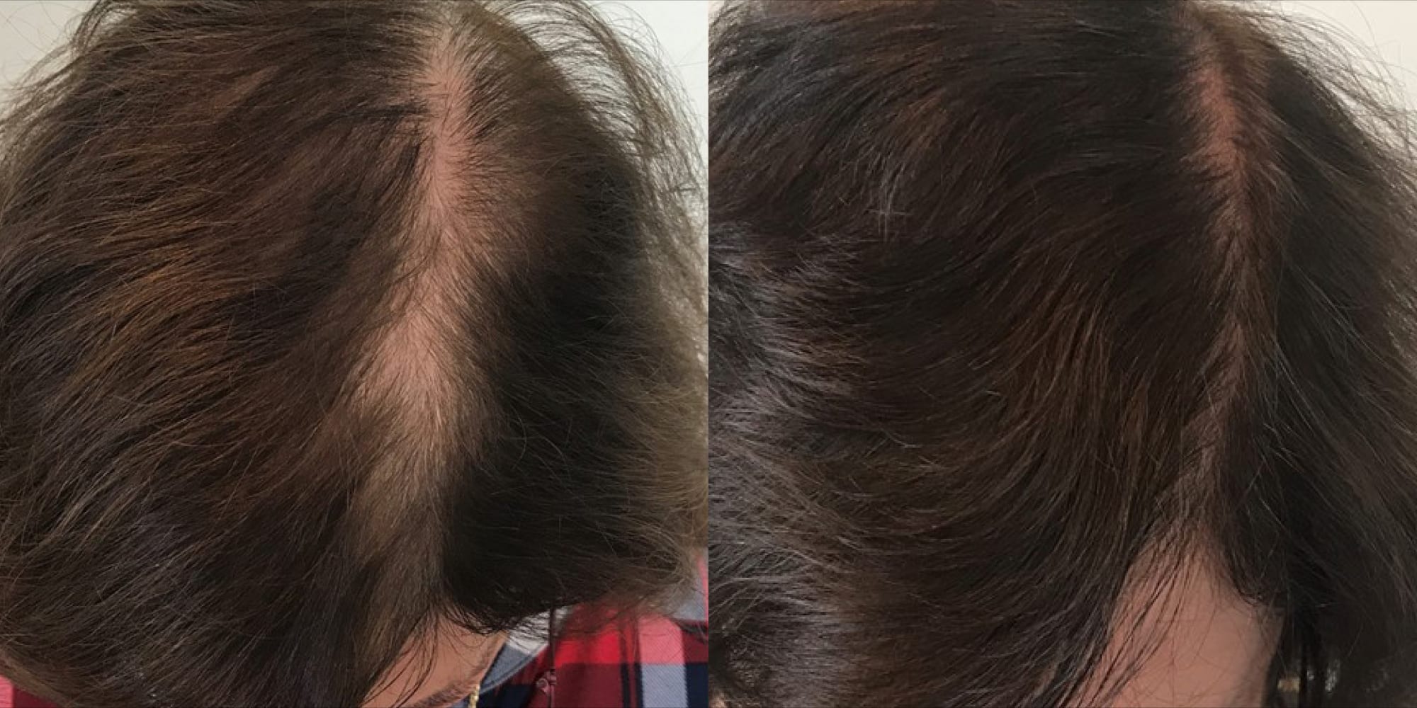 Hughes Center before and after keralase hair treatment