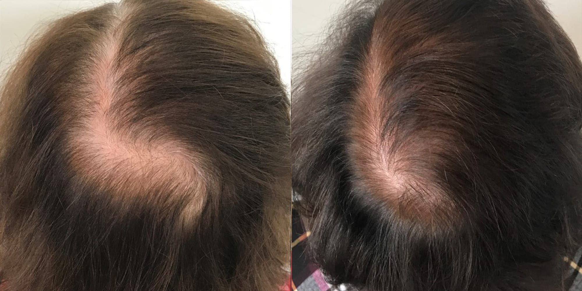 Hughes Center before and after keralase hair