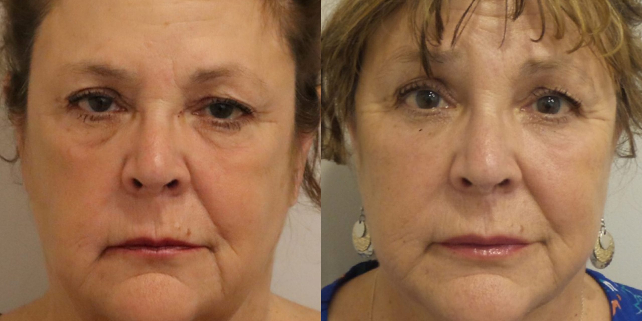 Hughes Center before and after facial treatment