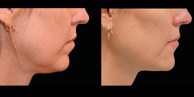 Before and After photo of an Emface Submentum patient from The Hughes Center in Cherry Hill NJ