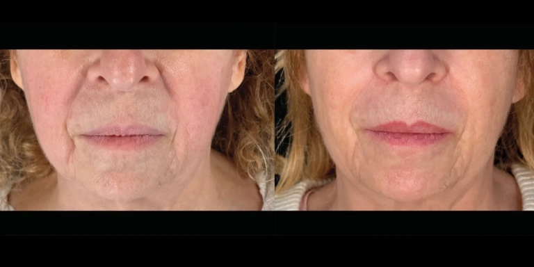 Before and After photo of an Emface patient from The Hughes Center in Cherry Hill NJ