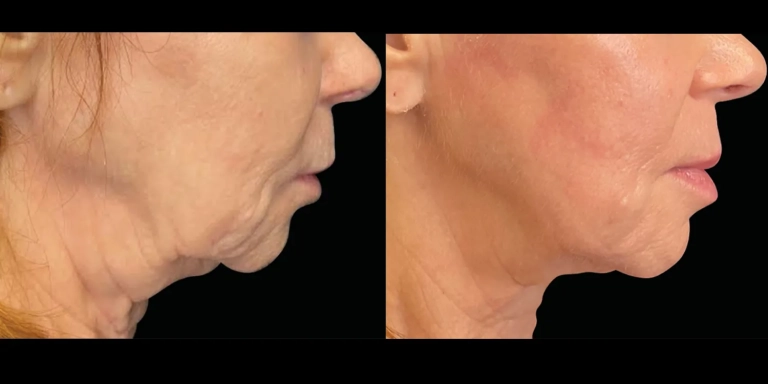 Before and After photo of an Emface Submentum patient from The Hughes Center in Cherry Hill NJ