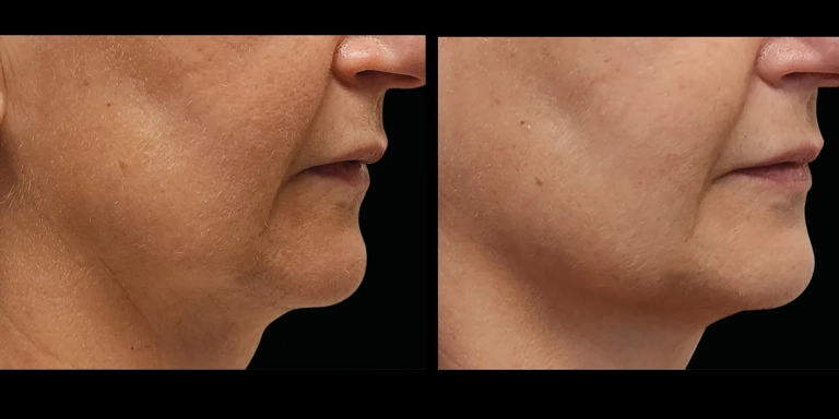 Before and After photo of an Emface Submentum patient from The Hughes Center in Cherry Hill NJ