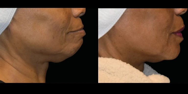 Before and After photo of an Emface Submentum patient from The Hughes Center in Cherry Hill NJ