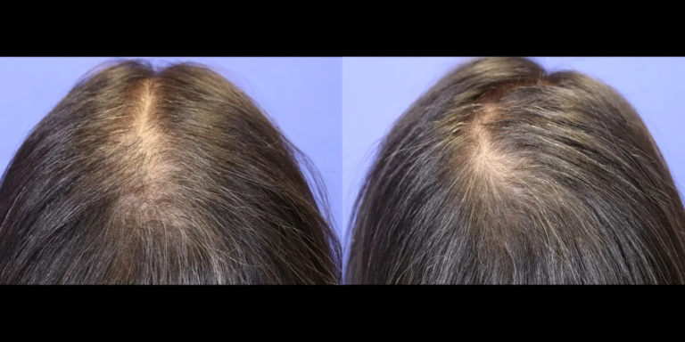 Case 1119 Hair B&A