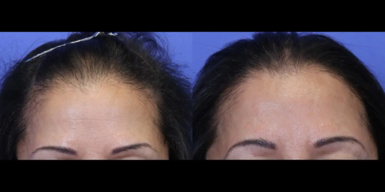 Case 1119 Hair B&A2