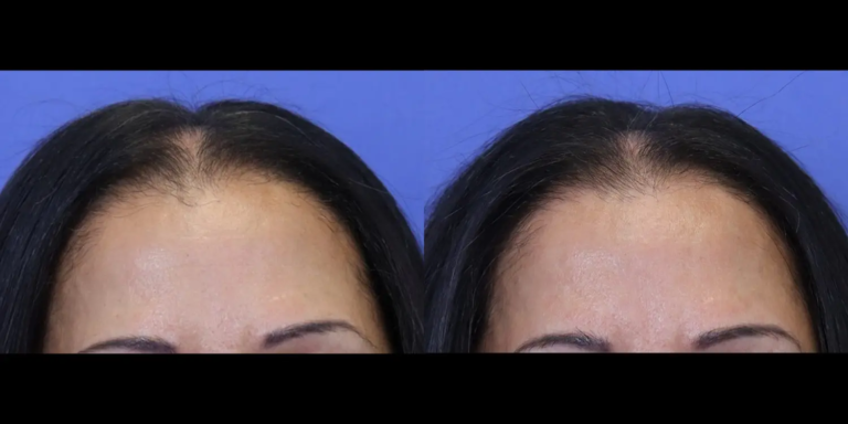 Case 1119 Hair B&A3