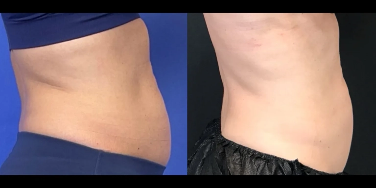 Before and After photo of an Emsculpt Neo patient from The Hughes Center in Cherry Hill NJ