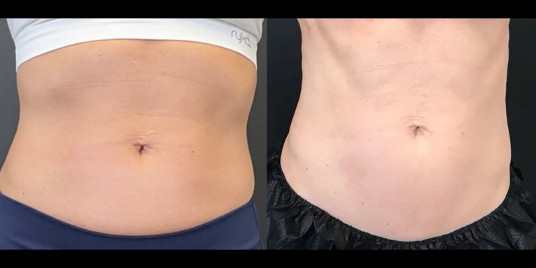 Before and After photo of an Emsculpt Neo patient from The Hughes Center in Cherry Hill NJ