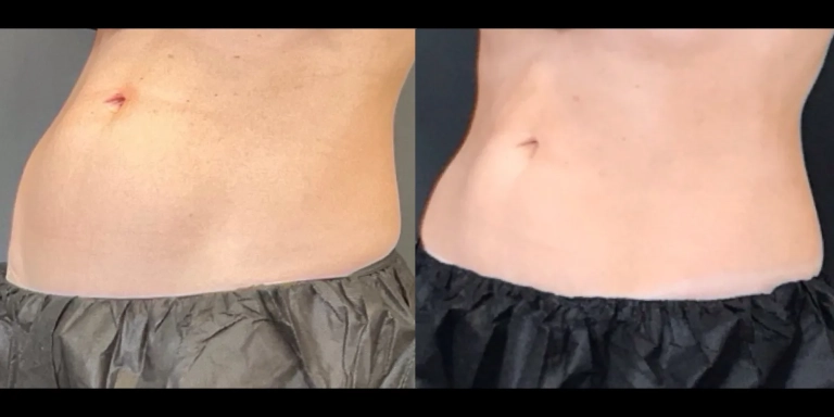 Before and After photo of an Emsculpt Neo patient from The Hughes Center in Cherry Hill NJ