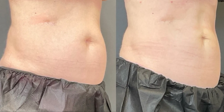 Before and After photo of an Emsculpt Neo patient from The Hughes Center in Cherry Hill NJ