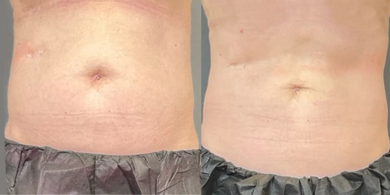 Before and After photo of an Emsculpt Neo patient from The Hughes Center in Cherry Hill NJ