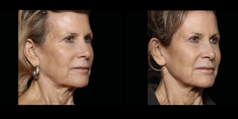 Before and After photo of an Emface patient from The Hughes Center in Cherry Hill NJ