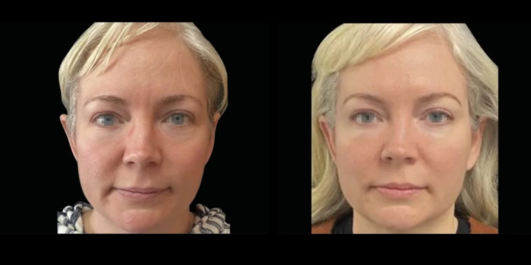 Before and After photo of an Emface patient from The Hughes Center in Cherry Hill NJ