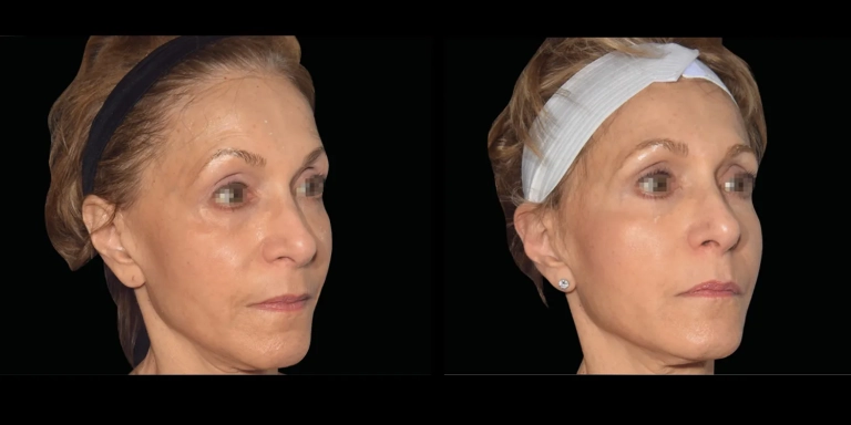 Before and After photo of an Emface patient from The Hughes Center in Cherry Hill NJ