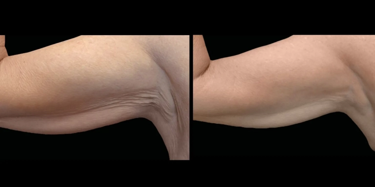 Before and After photo of an Exion patient from The Hughes Center in Cherry Hill NJ