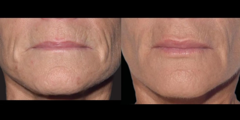 Before and After photo of an Exion patient from The Hughes Center in Cherry Hill NJ
