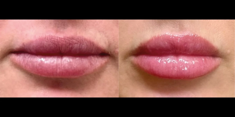 Before and After photo of an Exion patient from The Hughes Center in Cherry Hill NJ