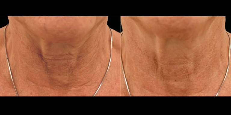Before and After photo of an Exion patient from The Hughes Center in Cherry Hill NJ