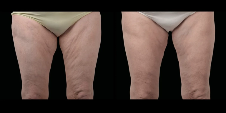 Before and After photo of an Exion patient from The Hughes Center in Cherry Hill NJ