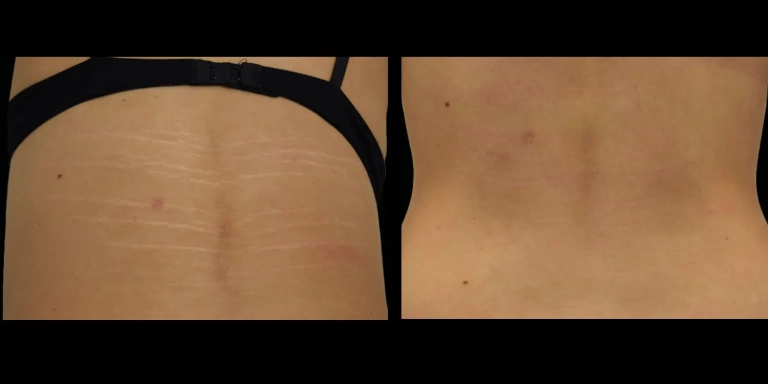 Before and After photo of an Exion patient from The Hughes Center in Cherry Hill NJ