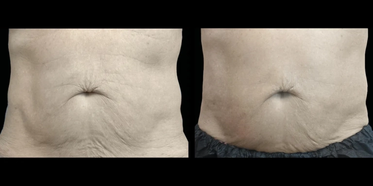 Before and After photo of an Exion patient from The Hughes Center in Cherry Hill NJ