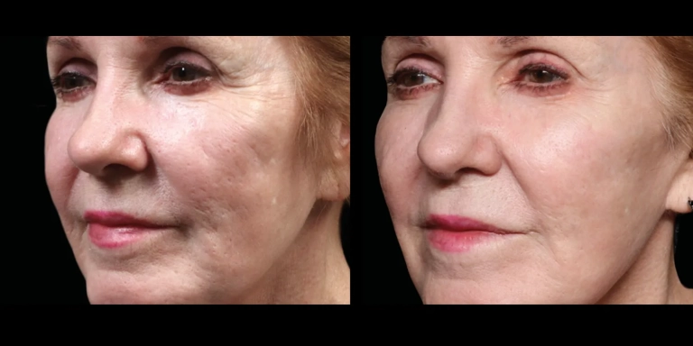Before and After photo of an Exion patient from The Hughes Center in Cherry Hill NJ