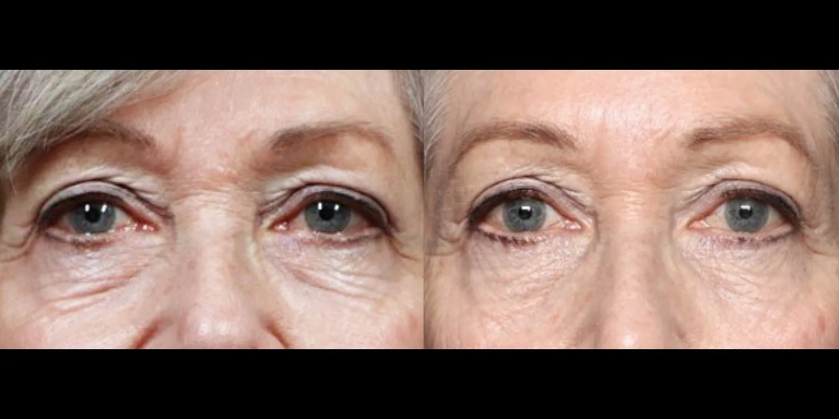 Before and After photo of an Exion patient from The Hughes Center in Cherry Hill NJ