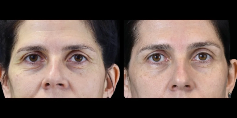 Before and After photo of an Exion patient from The Hughes Center in Cherry Hill NJ