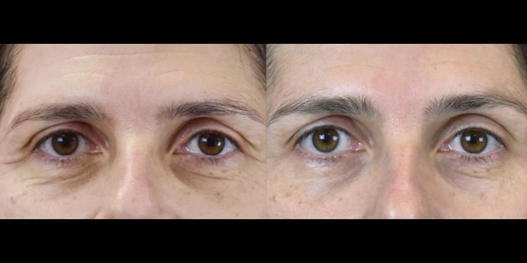 Before and After photo of an Exion patient from The Hughes Center in Cherry Hill NJ